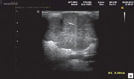 Diagnostic cu ultrasunete de boli ale glandelor salivare - Ustinov
