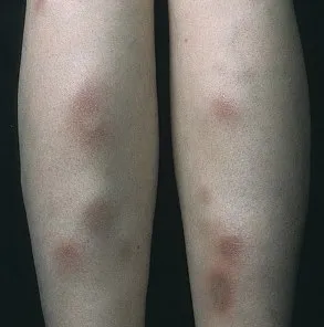 Erythema nodosum tünetek és a kezelés