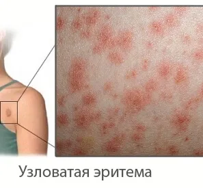 Erythema nodosum tünetek és a kezelés