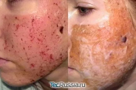 Skin Care után lézeres visszatérő vagy peeling - receptek gyors helyreállítás