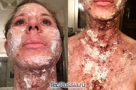 Skin Care után lézeres visszatérő vagy peeling - receptek gyors helyreállítás