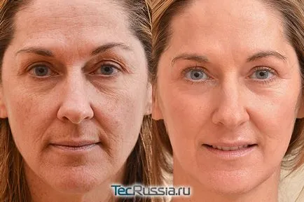 Skin Care után lézeres visszatérő vagy peeling - receptek gyors helyreállítás