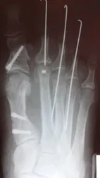 etape de tratament valgus deformare valgus de funcționare, traume și ortopedice Petrosyan