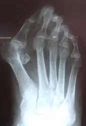 etape de tratament valgus deformare valgus de funcționare, traume și ortopedice Petrosyan