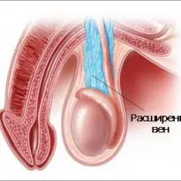 Varicocele üzemeltetés és hasznosítás