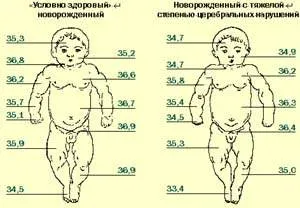 tulburări vegetative-viscerale la nou-nascuti cu leziuni cerebrale perinatale, # 03