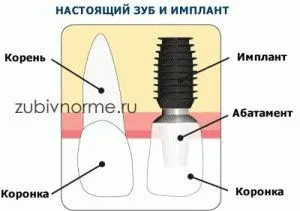 Care este principalul avantaj al implanturilor BICON în comparație cu alte