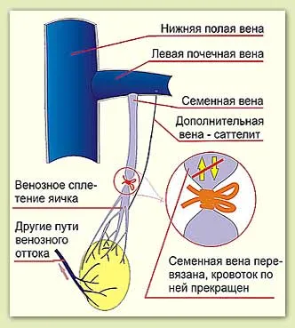 Varicocele üzemeltetés és hasznosítás