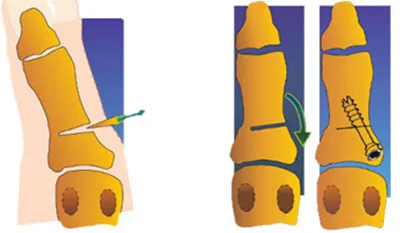 etape de tratament valgus deformare valgus de funcționare, traume și ortopedice Petrosyan