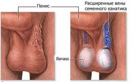 grad varicocel 3 simptome, diagnostic, tratament