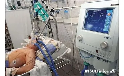 Coma a stroke, mint a nap megy, az ok és a túlélés esélyeit