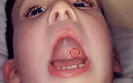 Варицела в устата на дете, отколкото да се методи и инструменти на процеса