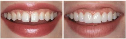 dinți de aliniere fără bretele pentru adulți - cele mai eficiente metode de aliniere
