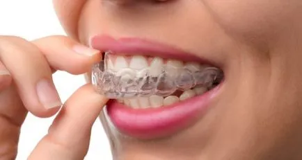 dinți de aliniere fără bretele pentru adulți - cele mai eficiente metode de aliniere