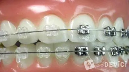 Подреждането на зъбите, без скоби или капачки - снимки и коментари