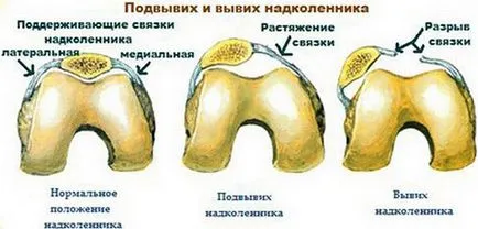 Разместване на съвместни симптомите на коляното и лечение на сублуксация на колянната става в дома