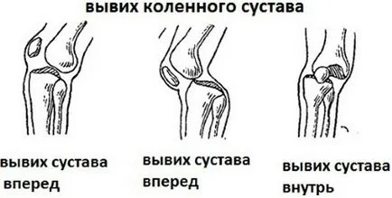 Dislocarea simptomele comune genunchiului și tratamentul subluxație articulației genunchiului în casă