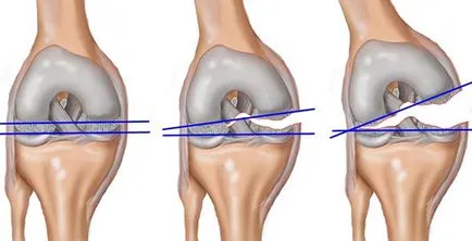 Разместване на съвместни симптомите на коляното и лечение на сублуксация на колянната става в дома