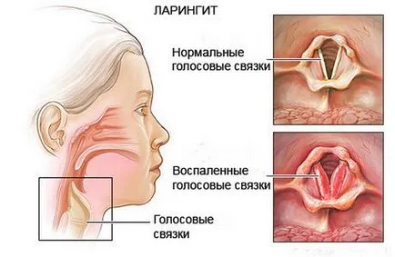 Вирусни ларингит при деца и възрастни, симптоми и лечение