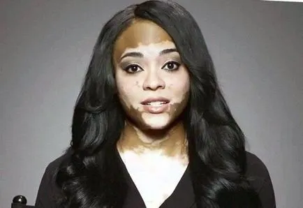 Vitiligo kezelése és okait