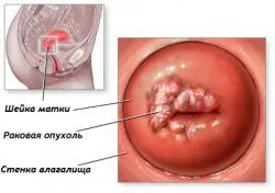 Întrebarea periculoasă decât displazie de col uterin