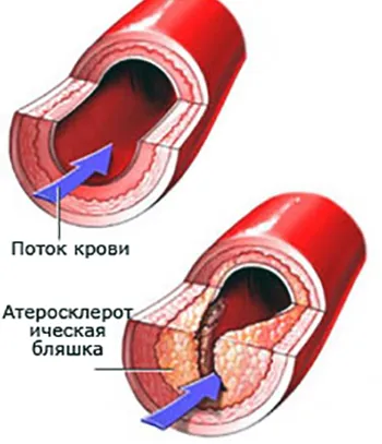 Kérdés-válasz után átesett egy MRI felfedezték, hogy volt egy kisebb stroke