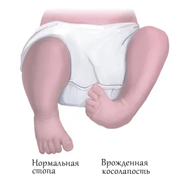 congenitale la copii picior stramb