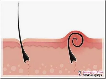 firele de păr incarnate pe picioare Care sunt cauzele și cum să se ocupe cu ei