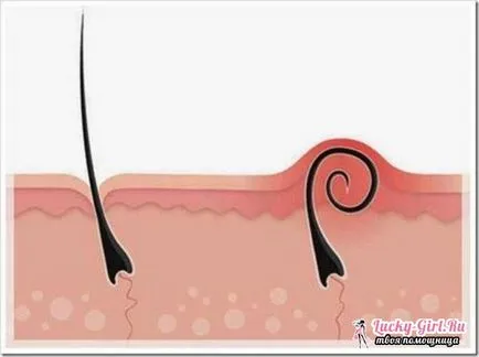 Подкожни косъмчета по краката Какви са причините и как да се справим с тях