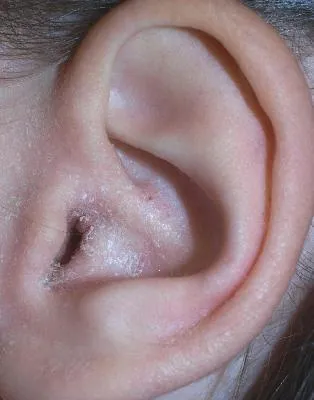 Boli ale urechii externe - erizipel ale urechii externe, tratamentul la Moscova