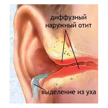 Заболявания на външното ухо - еризипел на външното ухо, лечението в Москва