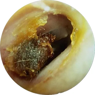 Заболявания на външното ухо - еризипел на външното ухо, лечението в Москва