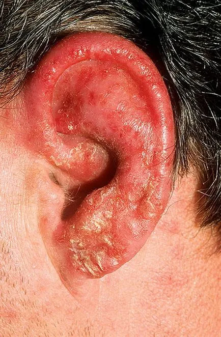 Заболявания на външното ухо - еризипел на външното ухо, лечението в Москва