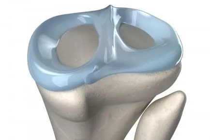 Замяна на менискуса на коляното, лекарите клиника Казан