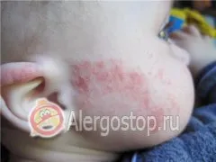 Алергии в 3 месеца - алергични деца