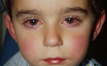 Allergiás rhinitis gyermekek, a kezelés, a tünetek és az okok