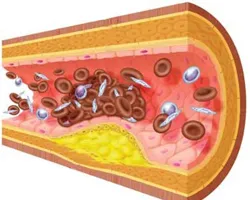 Cum de a diagnostica ateroscleroza - tratament de inima