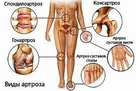 Osteoartrita - tratament la Marea Moarta