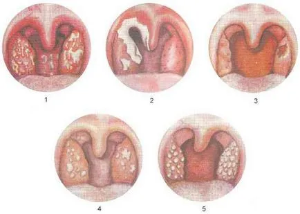 Augmentin ангина как да се прилагат