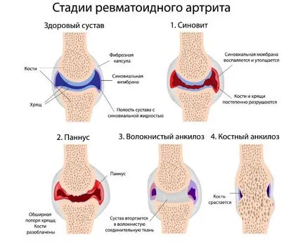 Artrita a simptomelor genunchiului si tratamentul bolii, metodele de tratament