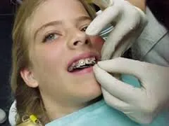 Braces gyerekeknek útmutatást alkalmazása és kiválasztása