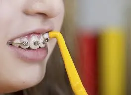 Braces gyerekeknek útmutatást alkalmazása és kiválasztása