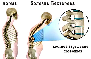 Bechterew-kór (spondylitis) kezelésére, a tünetek a férfiak, nők