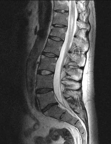 Bechterew-kór (spondylitis) kezelésére, a tünetek a férfiak, nők