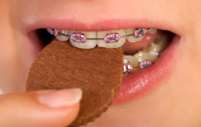 Braces gyerekeknek útmutatást alkalmazása és kiválasztása