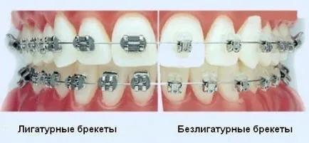 Bretele pentru copii de orientare privind aplicarea și selecția