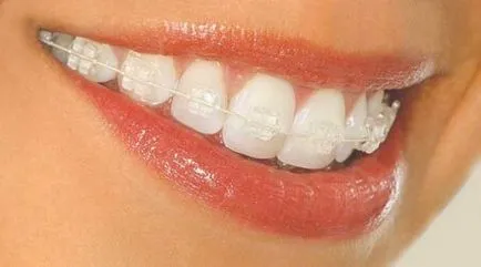 Braces gyerekeknek útmutatást alkalmazása és kiválasztása