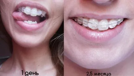 Braces gyerekeknek útmutatást alkalmazása és kiválasztása