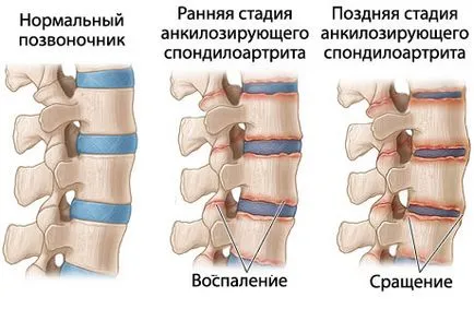 Bechterew-kór (spondylitis) kezelésére, a tünetek a férfiak, nők