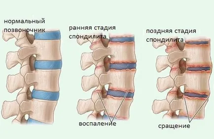 Spondylitis ankylopoetica - MRI-központ